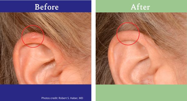 Before and after images of basal cell skin cancer on a person's ear treated with GentleCure.