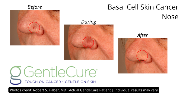 Before, during and after images of basal cell skin cancer on a nose treated with GentleCure